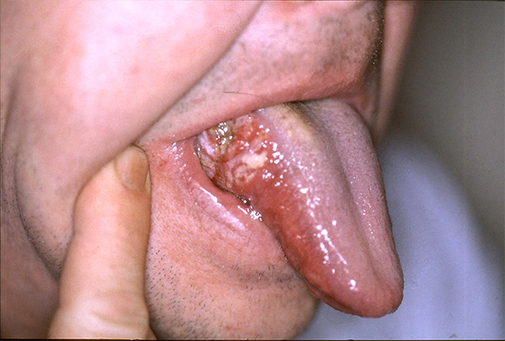 A person's tongue showing oral cancer